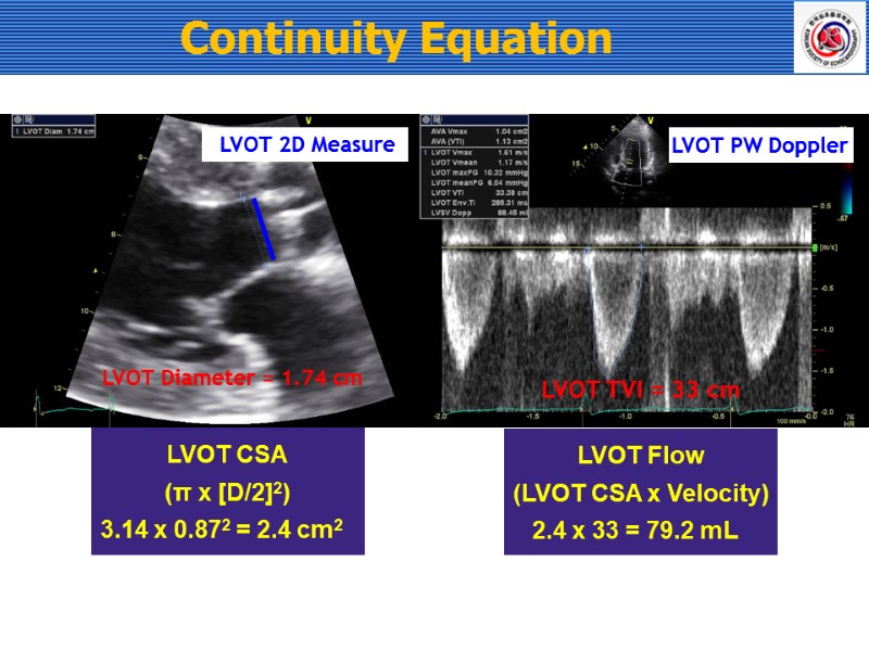 LVOT 2D Measure Continuity Equation